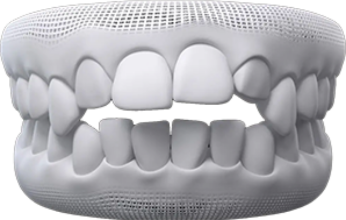 invisalign before after